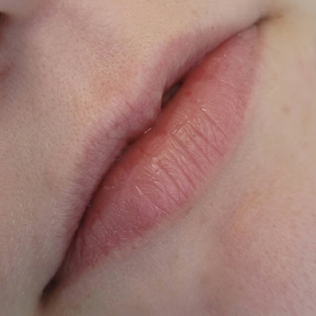 Thin Lips Before