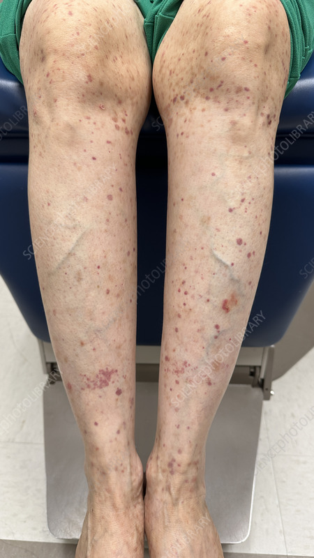 Vasculitis Leg Ulcers